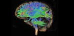 Read more about the article Advanced MRI scans help identify one in three concussion patients with ‘hidden disease’